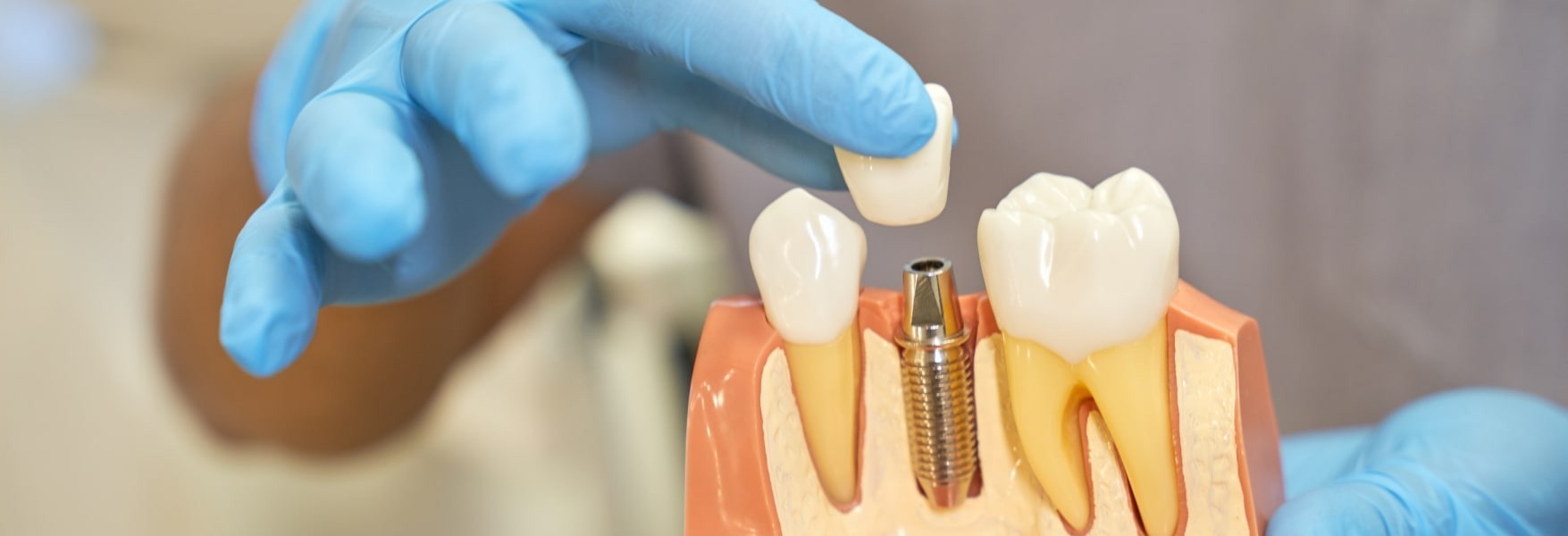 All-On-4 Dental Implants